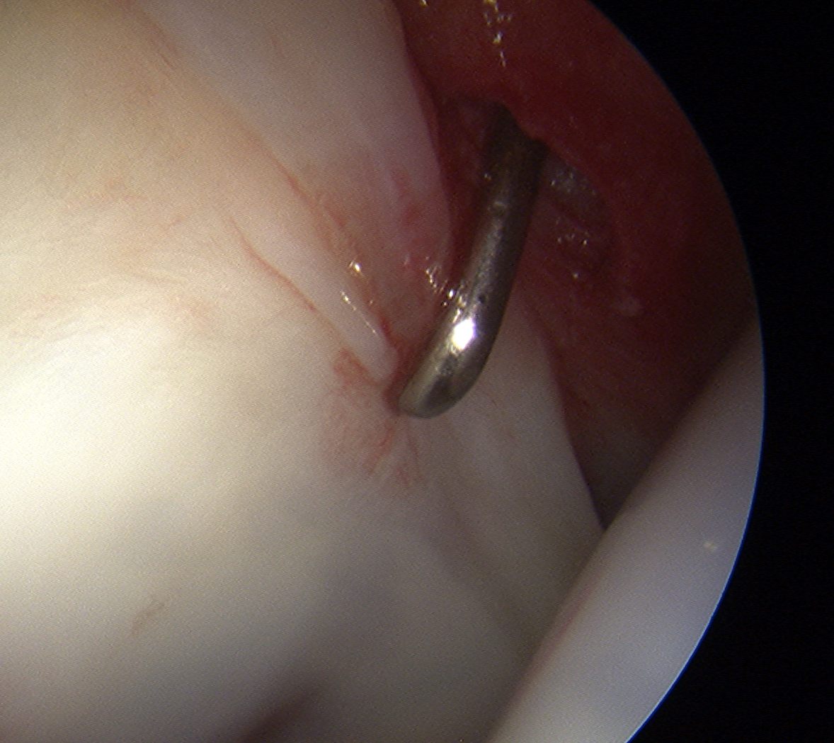 Hip scope normal acetabular Labrum